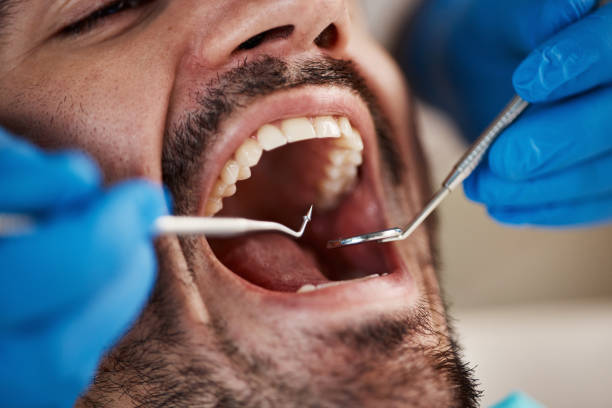 Best Emergency Wisdom Teeth Removal in Tipton, IA